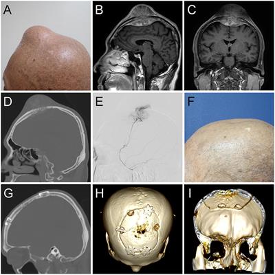Technical Case Report of a Cranioplasty With ex vivo Frozen Ostoblastic Bone Graft From Large Skull Metastasis